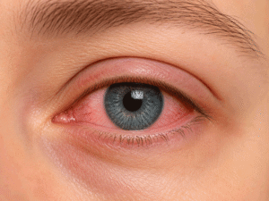 Close-up of an eye with conjunctivitis showing redness and irritation as a possible cause of eyelid pain.