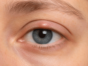 Medically realistic close-up of a mild eyelid bump showing a possible cause of why eyelids hurt.